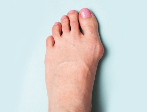 Saiba os diferentes tipos de joanetes